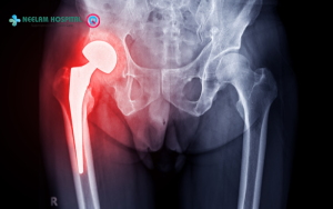 How long does it take to recover from hip replacement surgery?