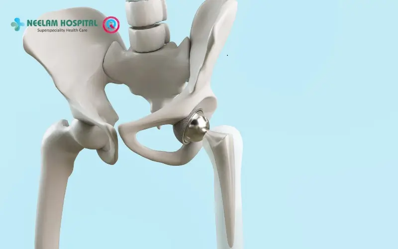 Hip Replacement Recovery Tips