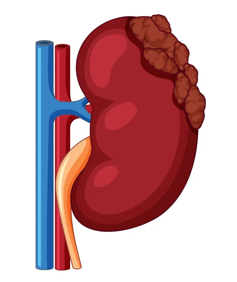 Robotic Nephrectomy Kidney Surgery