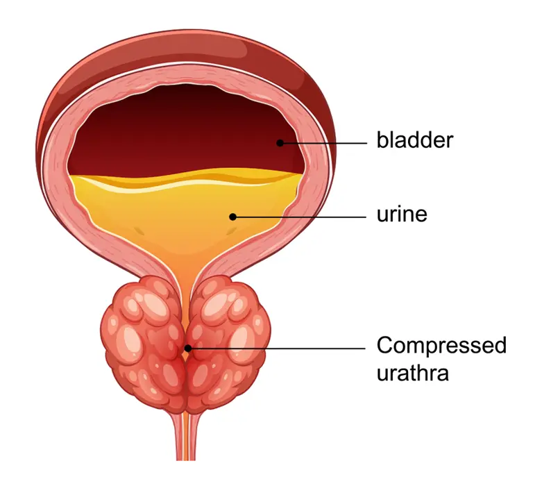 Robotic Radical Prostatectomy
