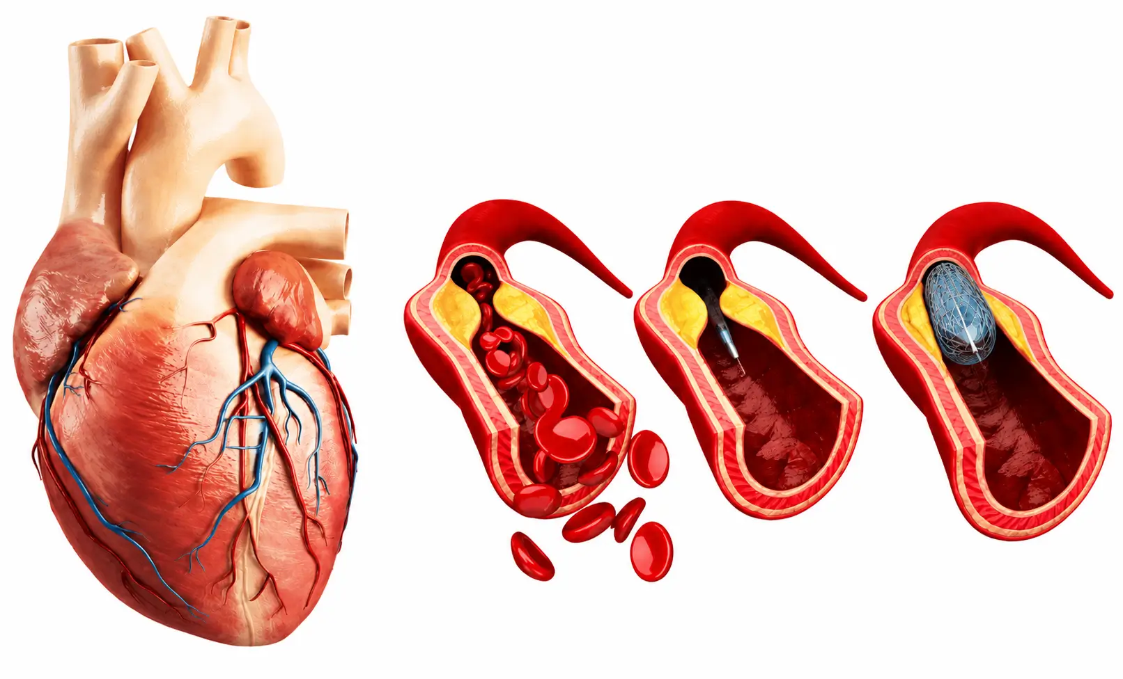 Angioplasty Procedure Heart Blockage Treatment Neelam Hospital