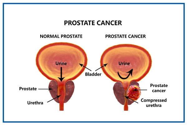 Prostate cancer compared with a normal prostate